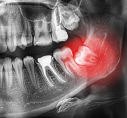 Treatment - Beaumontdental 